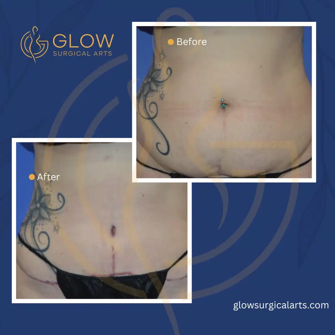 tummy tuck and mommy makeover in the bay area