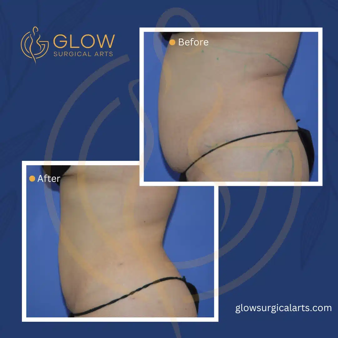 liposuction in fremont (the bay area cosmetic surgeon)