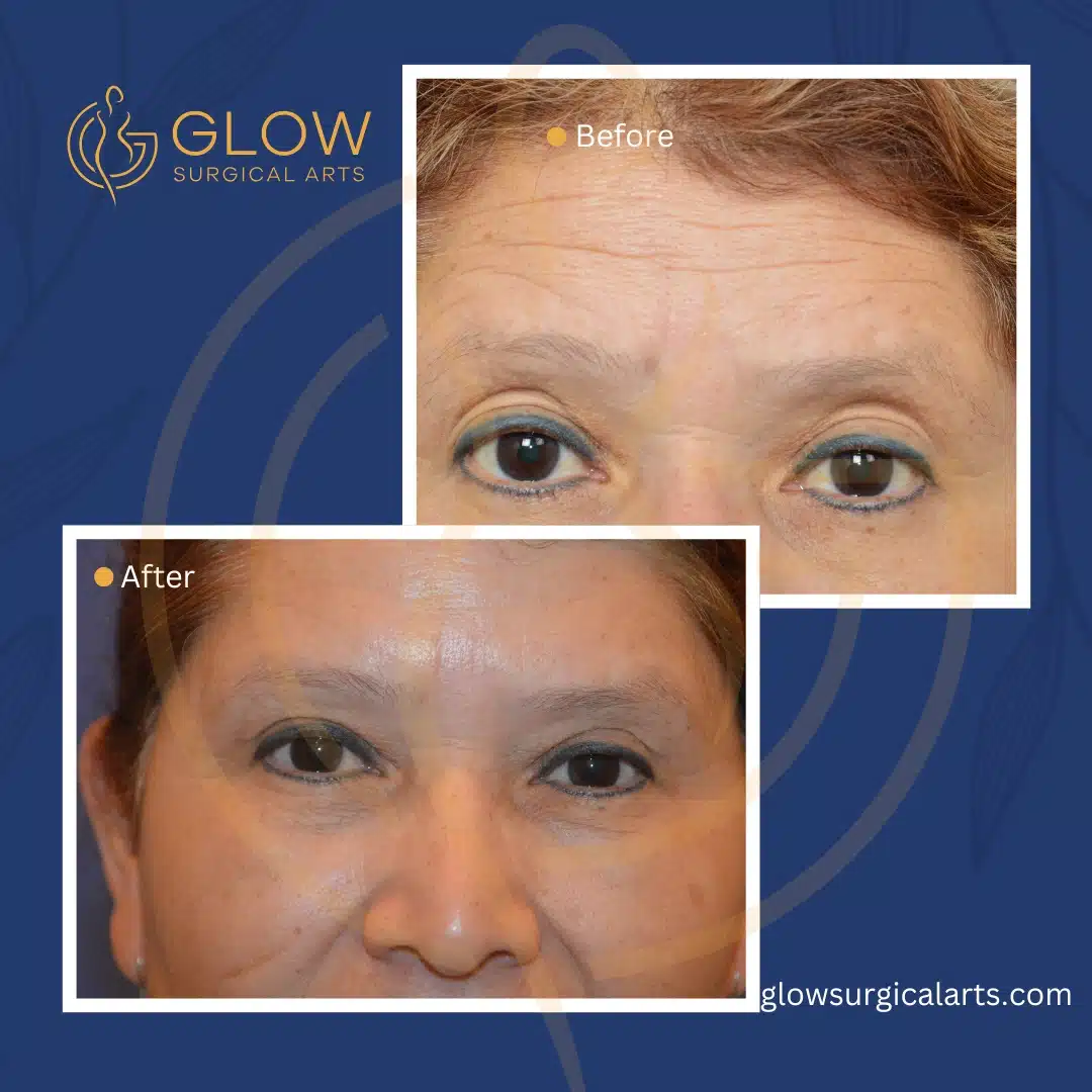 eyelid surgery (blepharoplasty) in the bay area