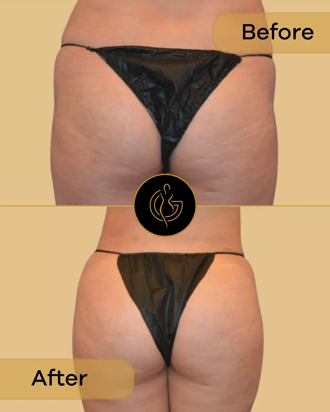 buttocks enhancement promotion near you