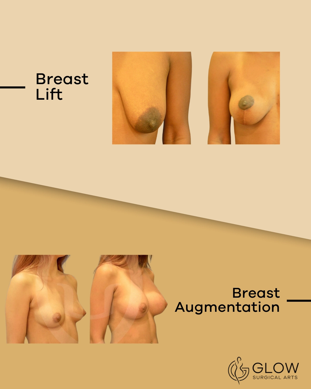 breast lift vs. augmentation