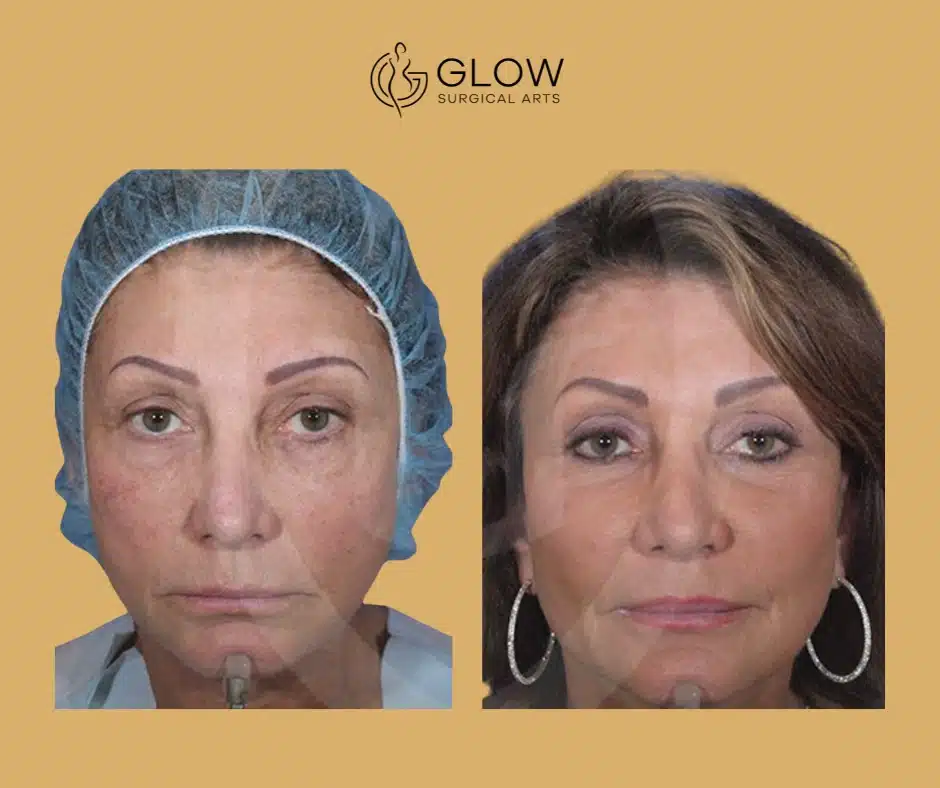 best face fat grafting procedures in fremont bay area