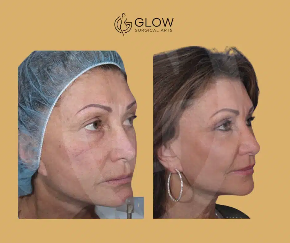 face fat grafting procedures bay area