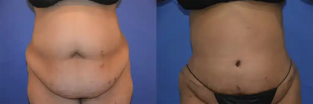 tummy tuck before and after photo by glow surgical arts in fremont ca