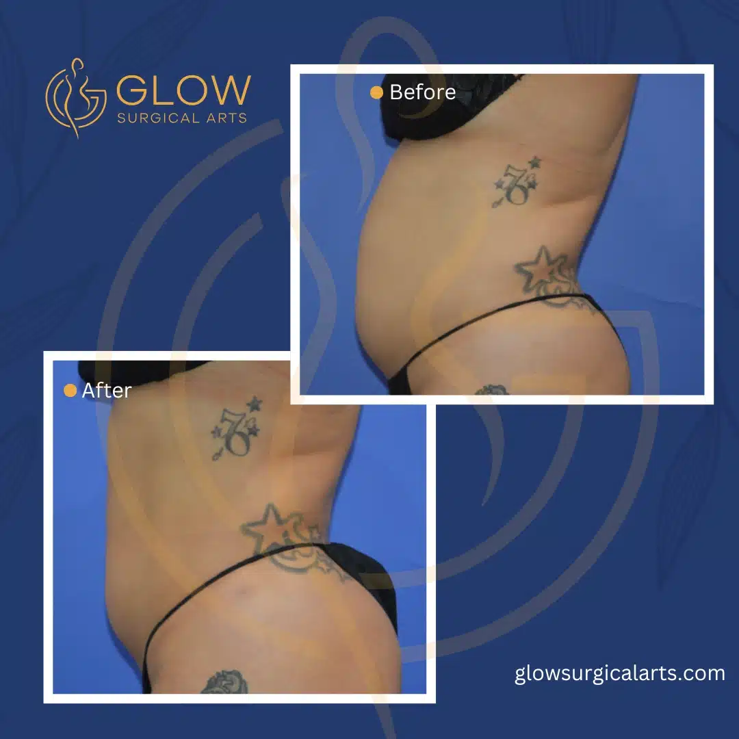 stomach (abdomen) liposuction in fremont and the bay area