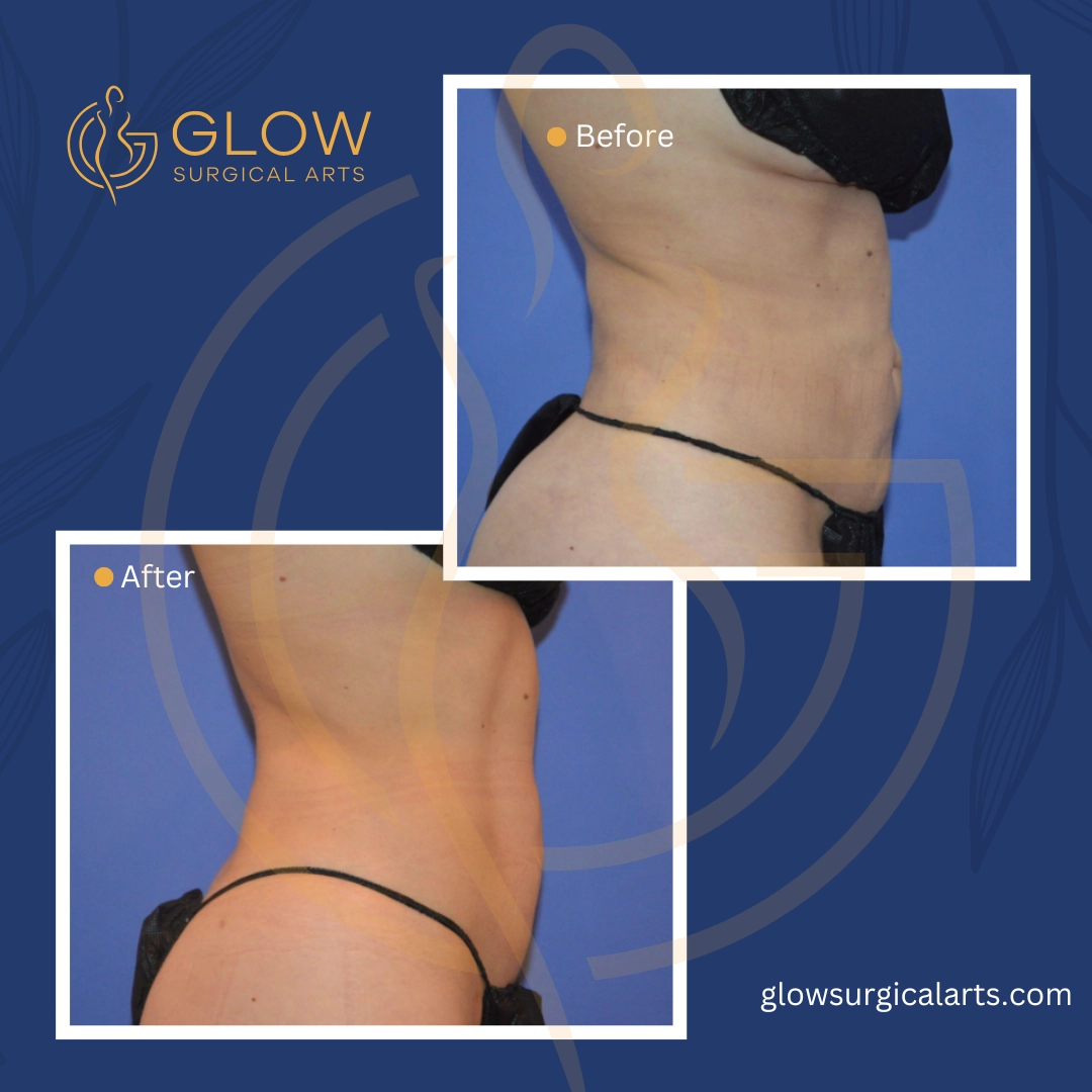 Post-Liposuction Care: Recovery Tips for Long-Term Success