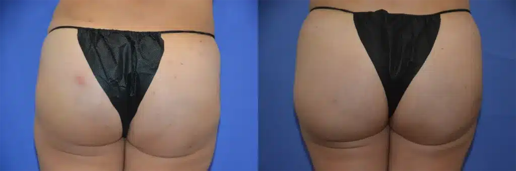 buttocks fat transfer before and after photo by glow surgical arts in fremont ca