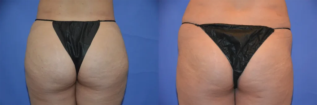 buttocks fat transfer before and after photo by glow surgical arts in fremont ca