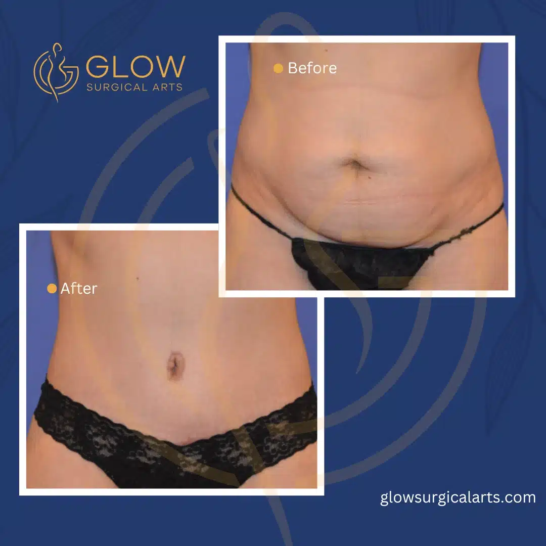 bay area tummy tuck procedures
