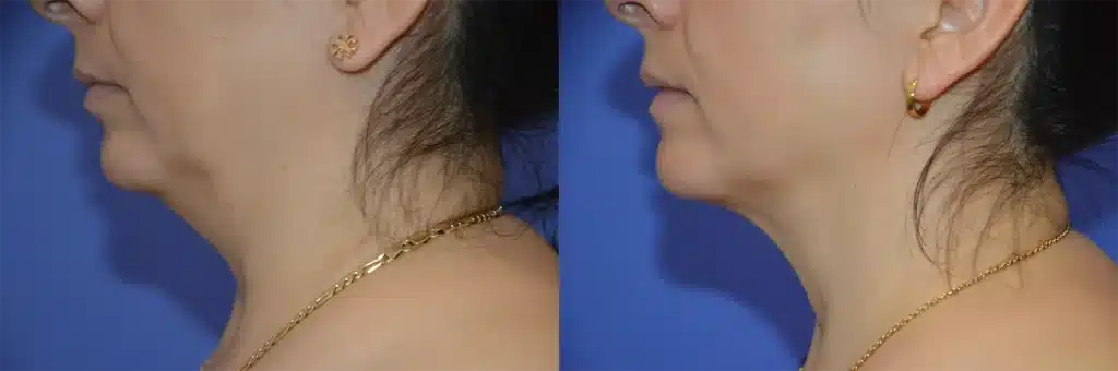 mommy makeover before and after photo by glow surgical arts in fremont ca