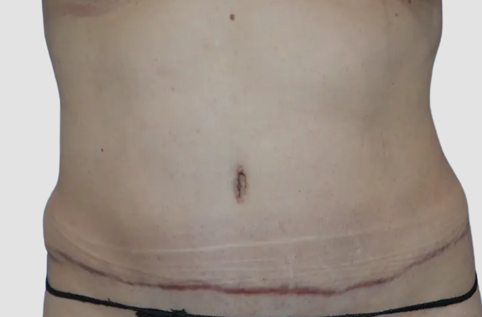 After Liposuction Patient Photo