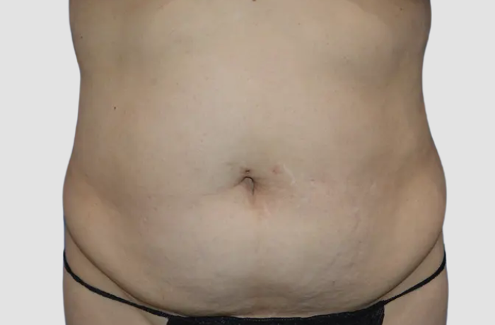 Before Liposuction Patient Photo