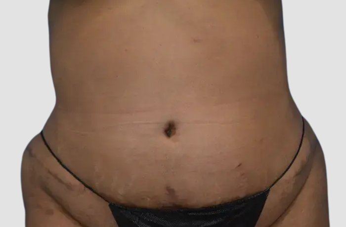After Abdominoplasty Surgery Patient Photo