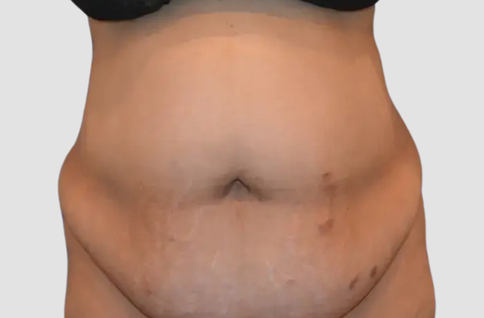 Before Abdominoplasty Surgery Patient Photo