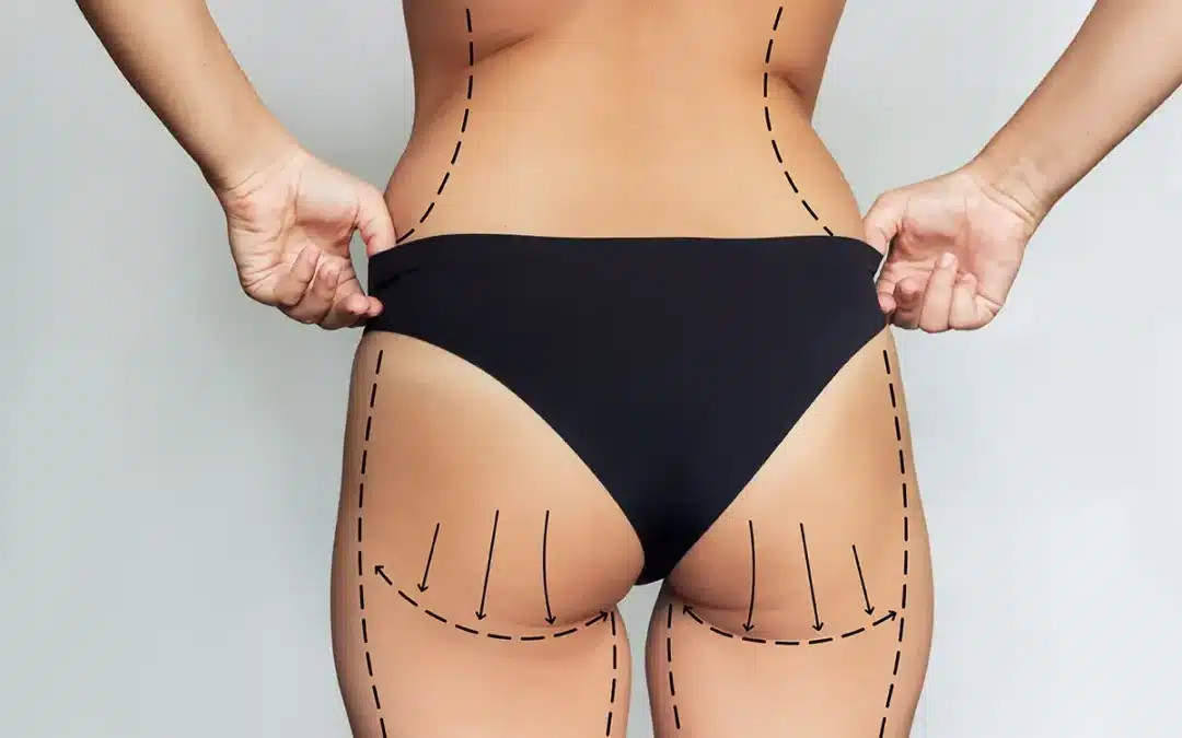 woman with excess fat and marks for liposuction or plastic surgery on her body