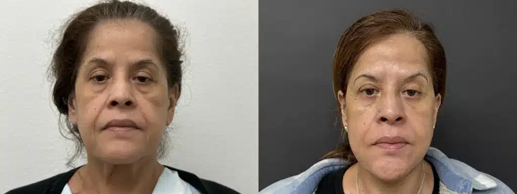 face neck lift before and after photo by glow surgical arts in fremont ca