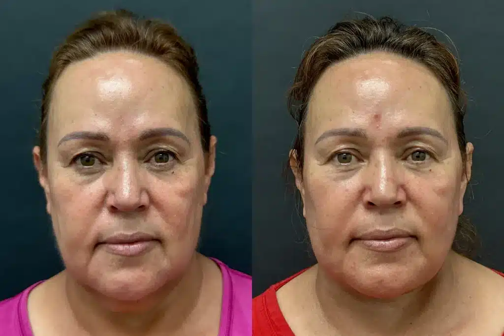 face neck lift before and after photo by glow surgical arts in fremont ca