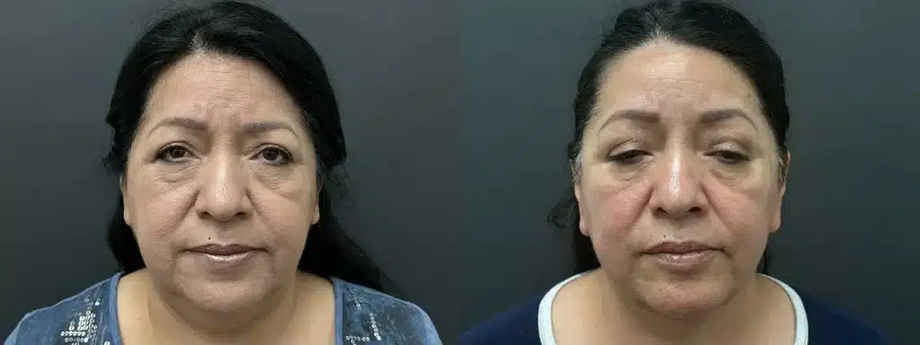 face neck lift before and after photo by glow surgical arts in fremont ca