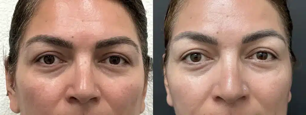eyelid lift before and after photo by glow surgical arts in fremont ca