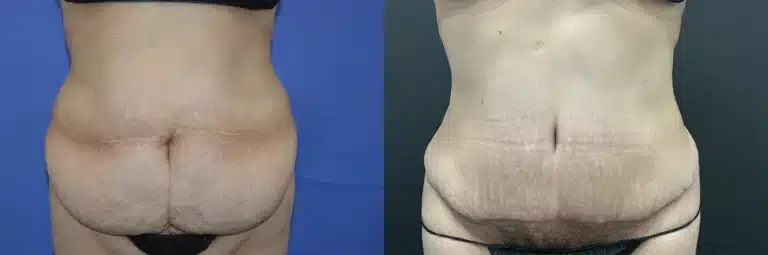 liposuction before and after photo by glow surgical arts in fremont ca