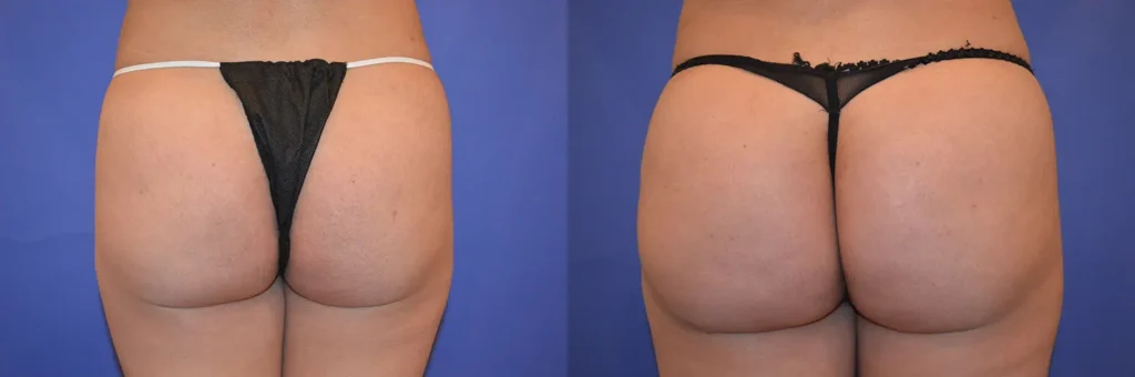 buttocks fat transfer before and after photo by glow surgical arts in fremont ca