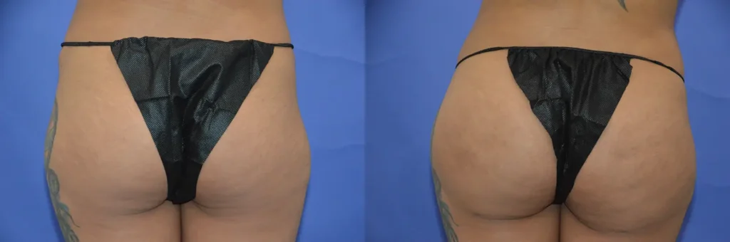 buttocks fat transfer before and after photo by glow surgical arts in fremont ca