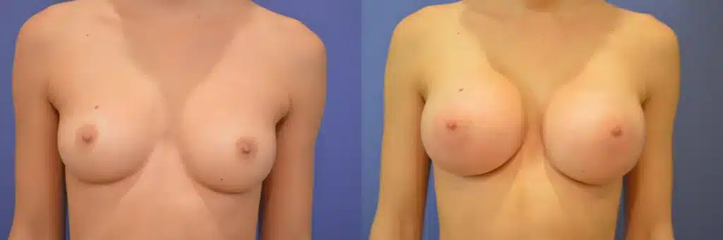 breast augmentation before and after photo by glow surgical arts in fremont ca