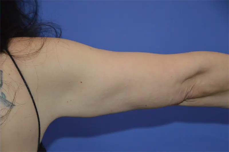 After Upper Arm Liposuction Patient Photo