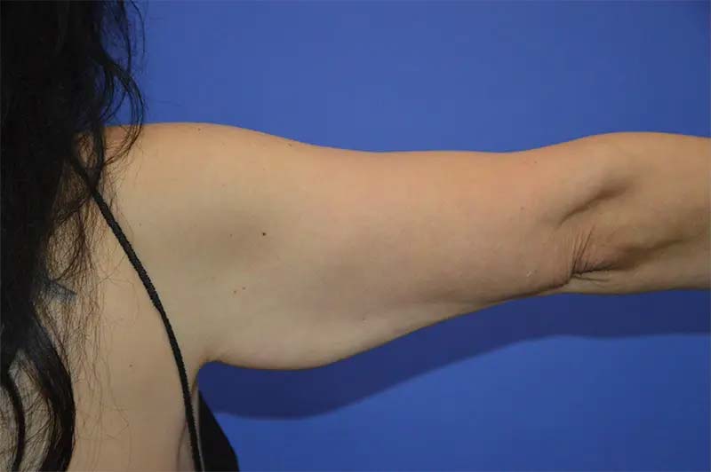 Before Upper Arm Liposuction Patient Photo