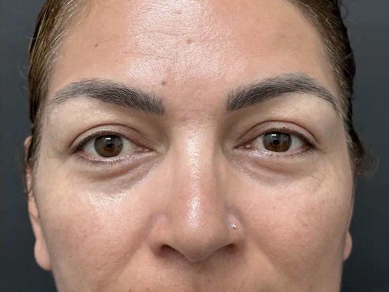 After Facial Surgery Patient Photo