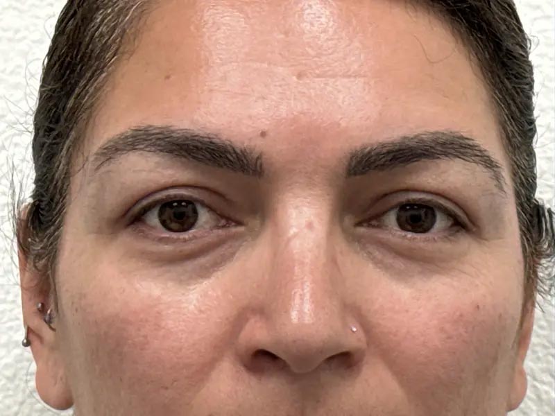 Before Facial Surgery Patient Photo