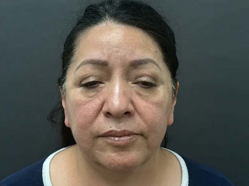 After Facial Surgery Patient Photo