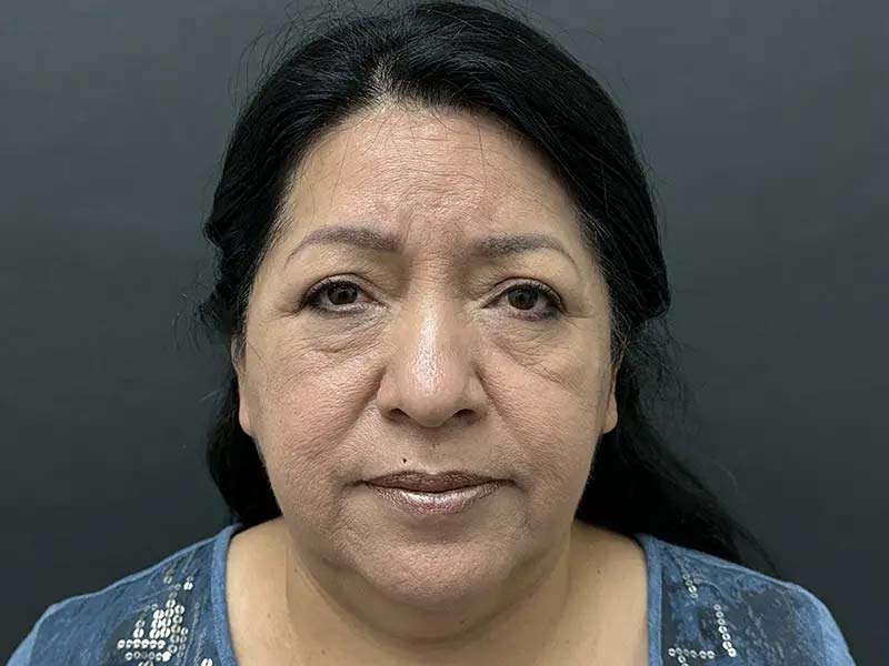 Before Facial Surgery Patient Photo