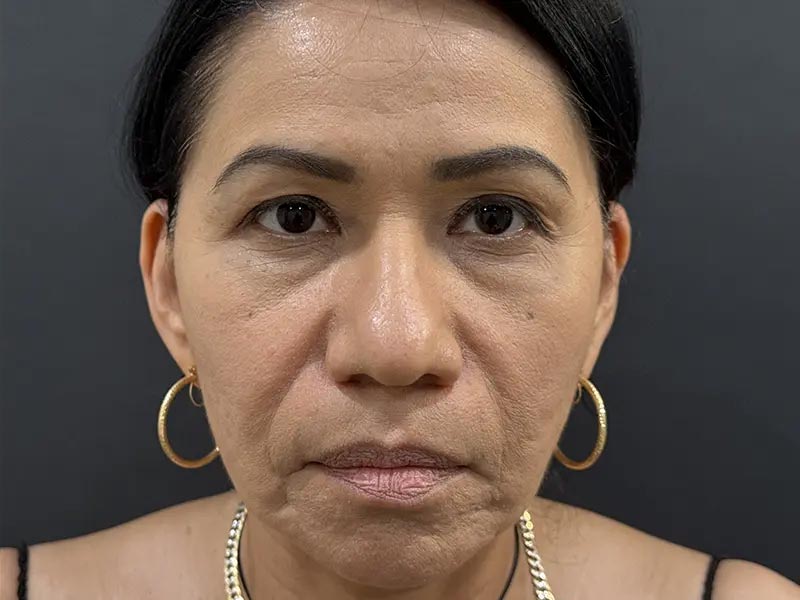 After Facial Surgery Patient Photo