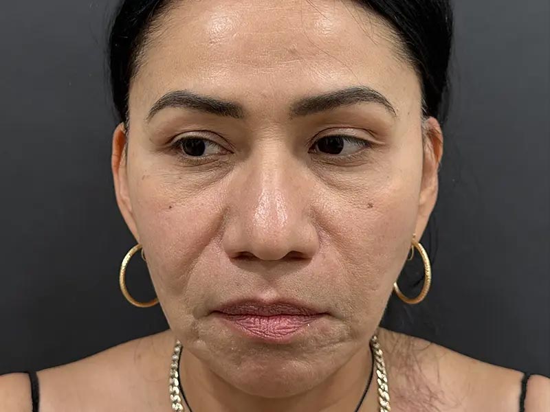 Before Facial Surgery Patient Photo